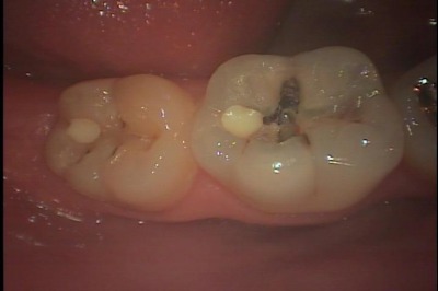 右下奥歯の深い虫歯の治療例 神経を残せた歯と神経を取らなければならなかった歯 一部保険診療 みつい歯科クリニック
