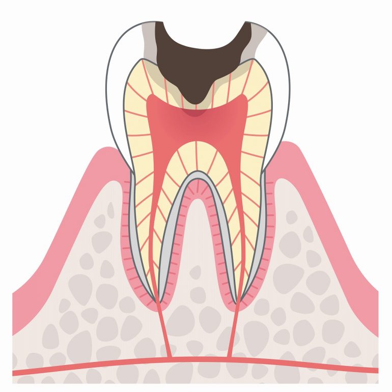 C3：神経に達したむし歯