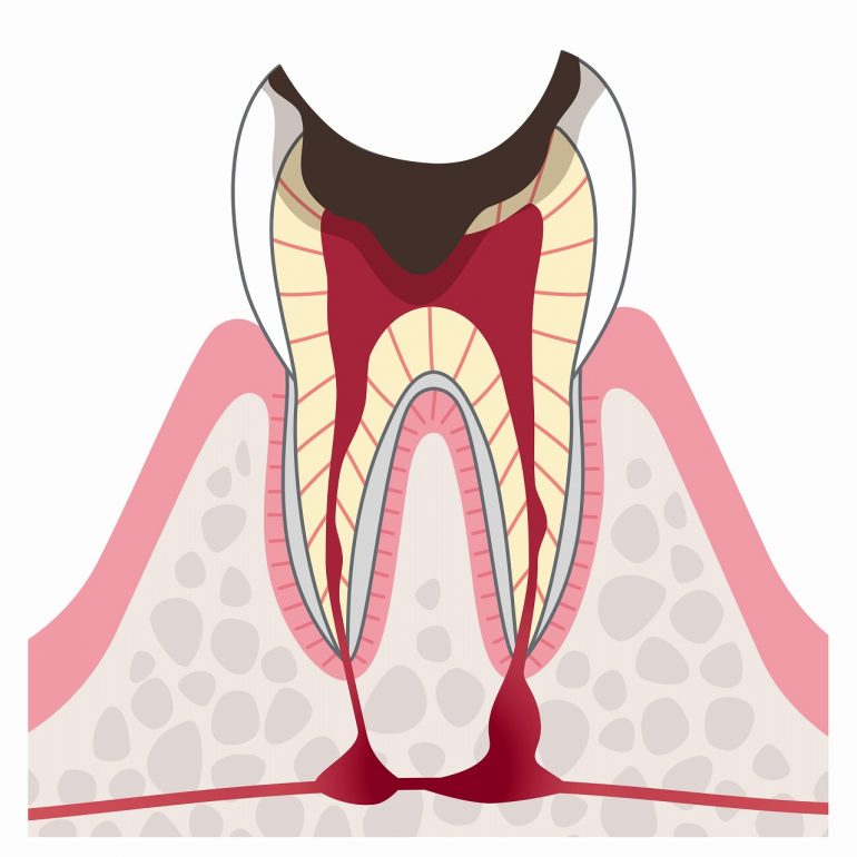 C4：歯根に達したむし歯