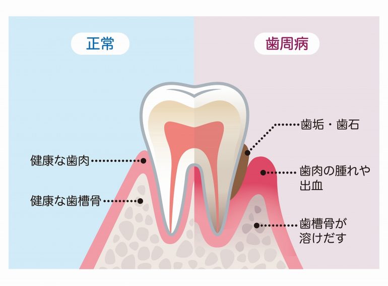 日本人に多い歯周病