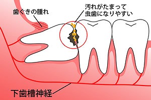 抜歯の基準